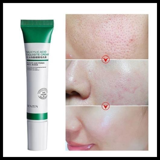 Creme De Ácido Salicílico 20ml Para Remoção E Clareamento De Poros/Acne/Controle De Óleo /